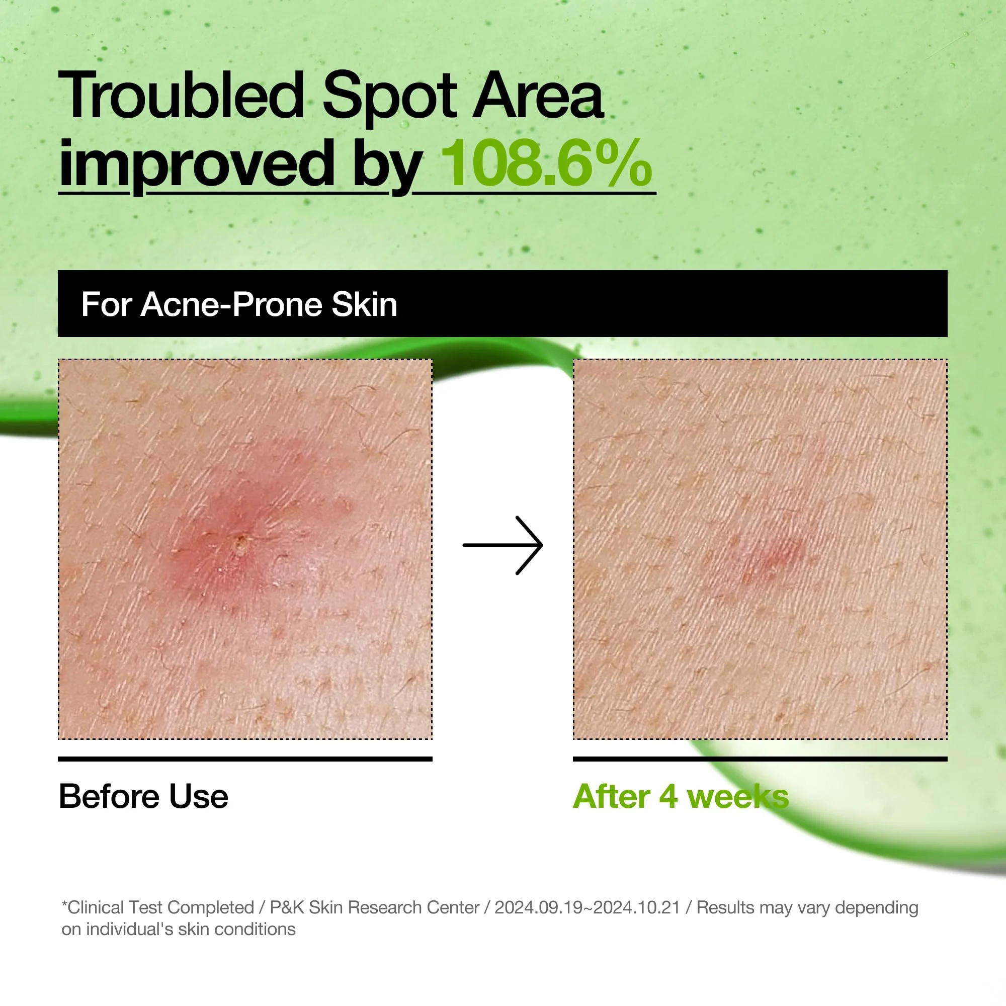 Anua Azelaic Acid 10 Hyaluron Redness Soothing Serum, Facial Serum for Blemish-Prone & Sensitive Skin, Lightweight & Hydrating Blemish Care, Hyaluronic Acid, Korean Skincare, 1.01 fl oz. - Image 6