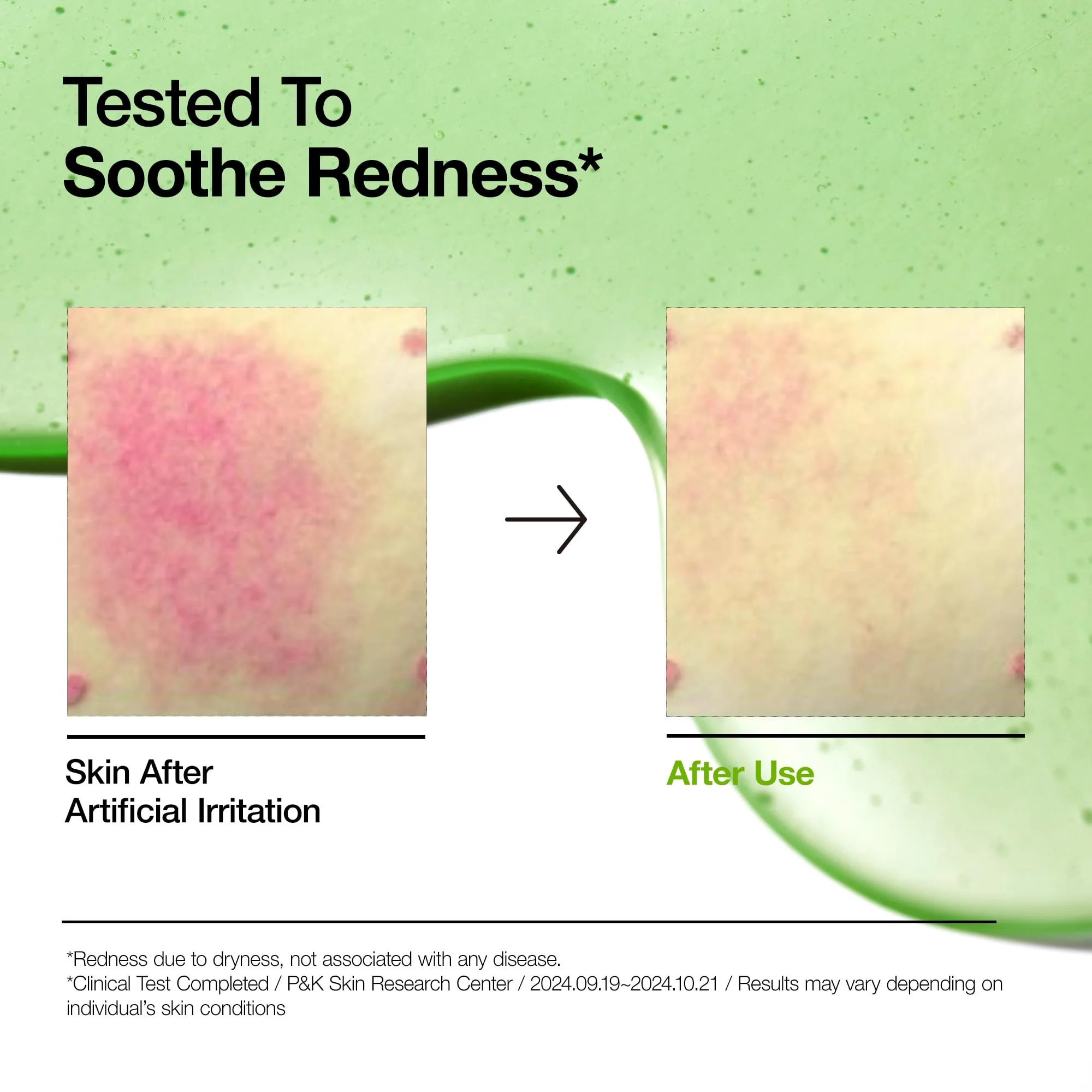 Anua Azelaic Acid 10 Hyaluron Redness Soothing Serum, Facial Serum for Blemish-Prone & Sensitive Skin, Lightweight & Hydrating Blemish Care, Hyaluronic Acid, Korean Skincare, 1.01 fl oz. - Image 8