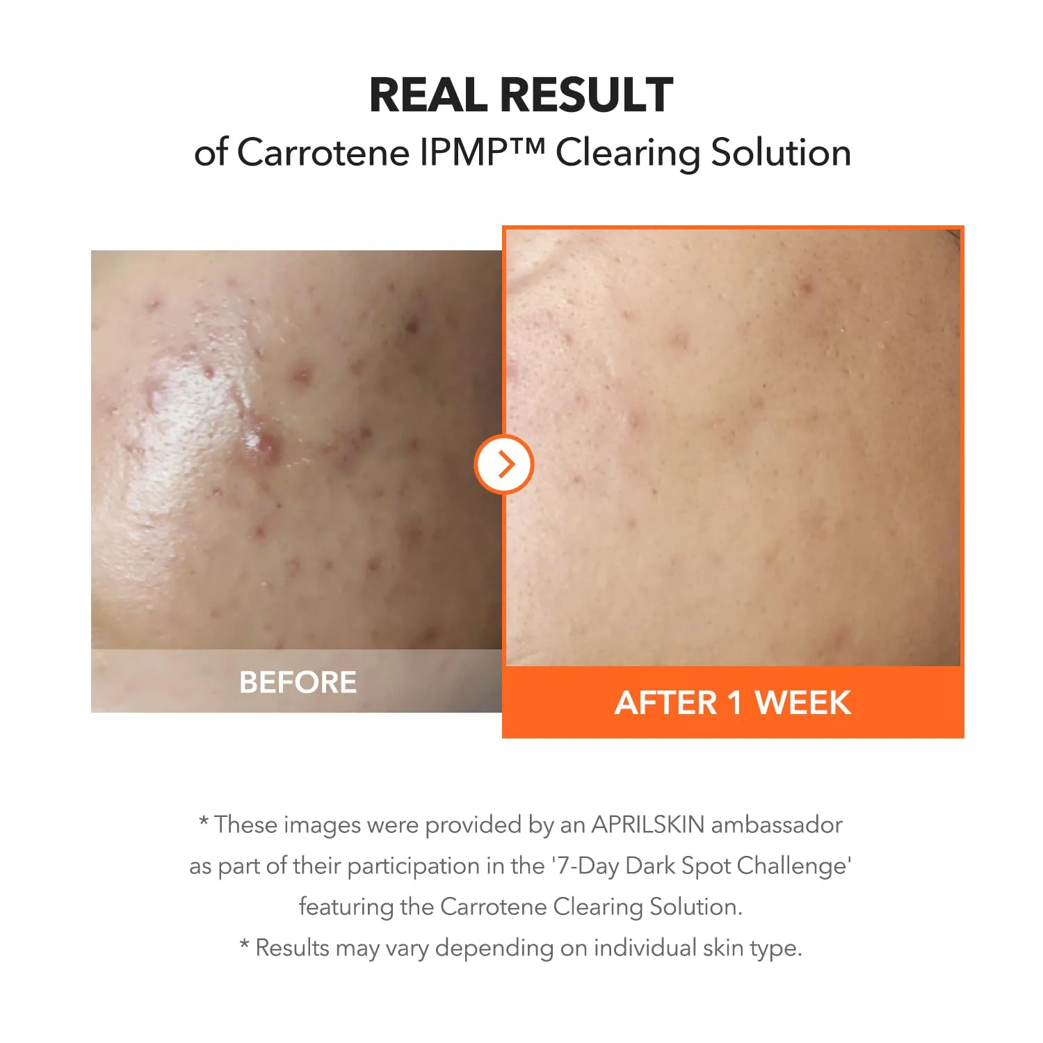 APRILSKIN Carrotene IPMP™ Clearing Solution || Quickly soothes troubled areas and helps clear blemishes | Formulated with BHA, AHA, Niacinamide & Zinc Oxide | Vegan, Cruelty-Free (0.67fl.oz.) - Image 6