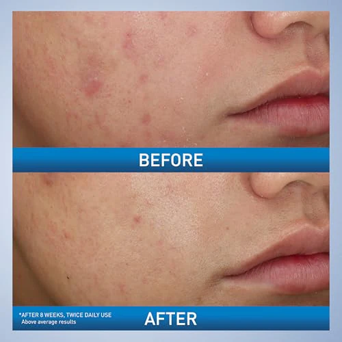 CeraVe Acne Foaming Cream Wash, Gentle Face and Body Cleanser with Benzoyl Peroxide 10%, Hyaluronic Acid, and Niacinamide, 10% Benzoyl Peroxide Treatment Clears Pimples and Blackheads 5 Oz - Image 9