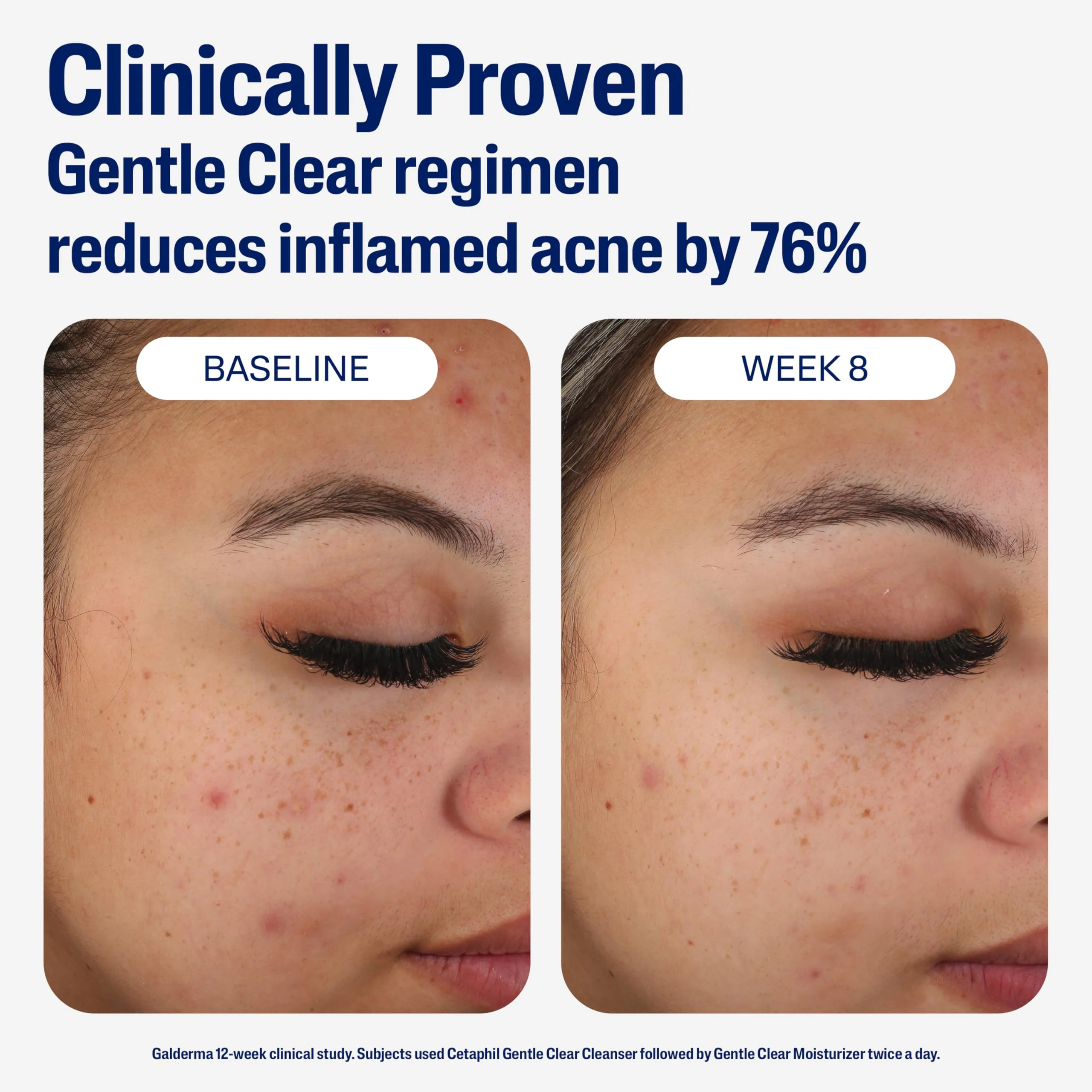 Cetaphil Face Moisturizer, Gentle Clear Mattifying Acne Moisturizer With 0.5% Salicylic Acid, Hydrates and Treats Sensitive Acne Prone Skin, Skin Care for Sensitive Skin, 3oz - Image 6