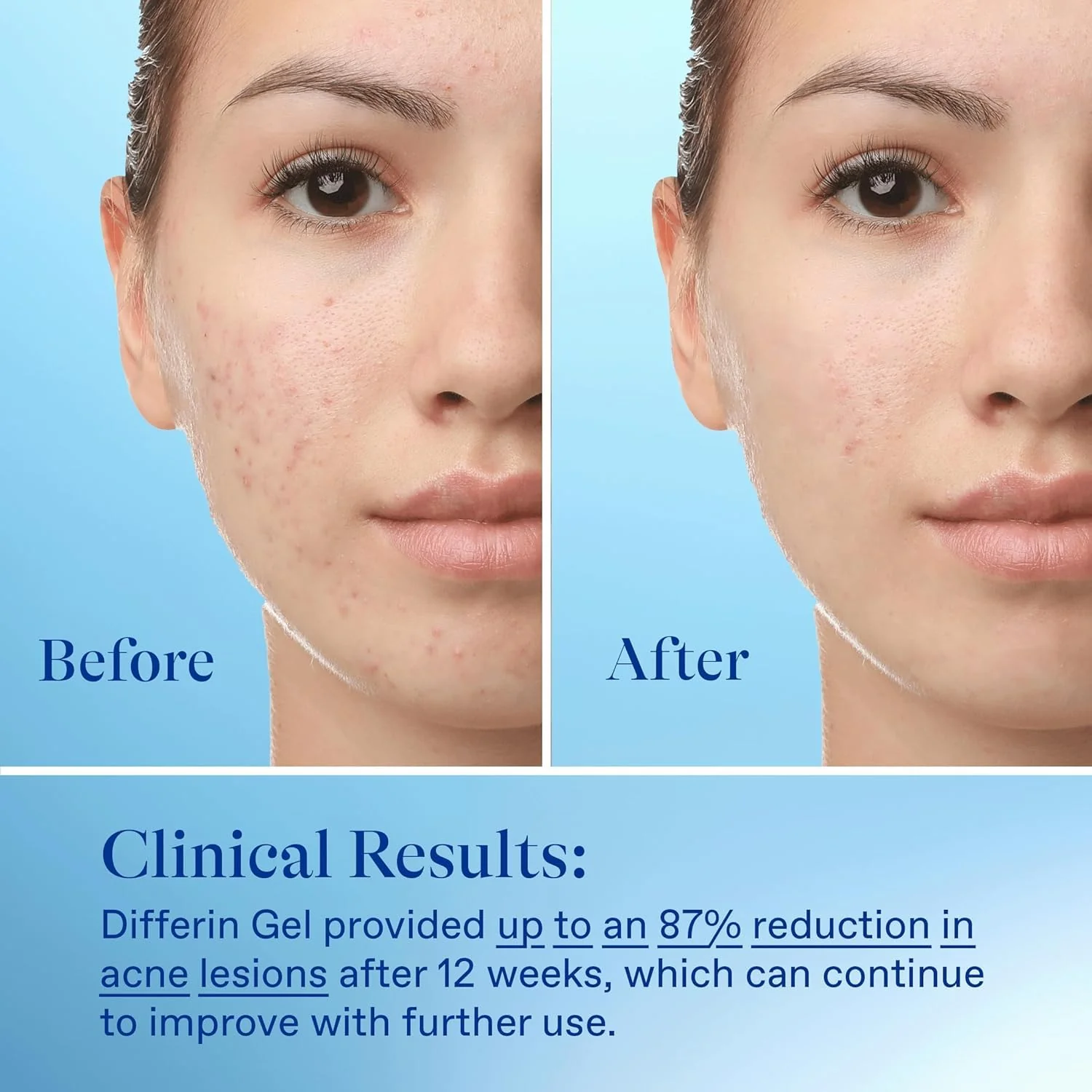 Differin Acne Treatment Gel, 30 Day Supply, Retinoid Treatment for Face with 0.1% Adapalene, Gentle Skin Care for Acne Prone Sensitive Skin, 15g Tube (Packaging May Vary) - Image 6