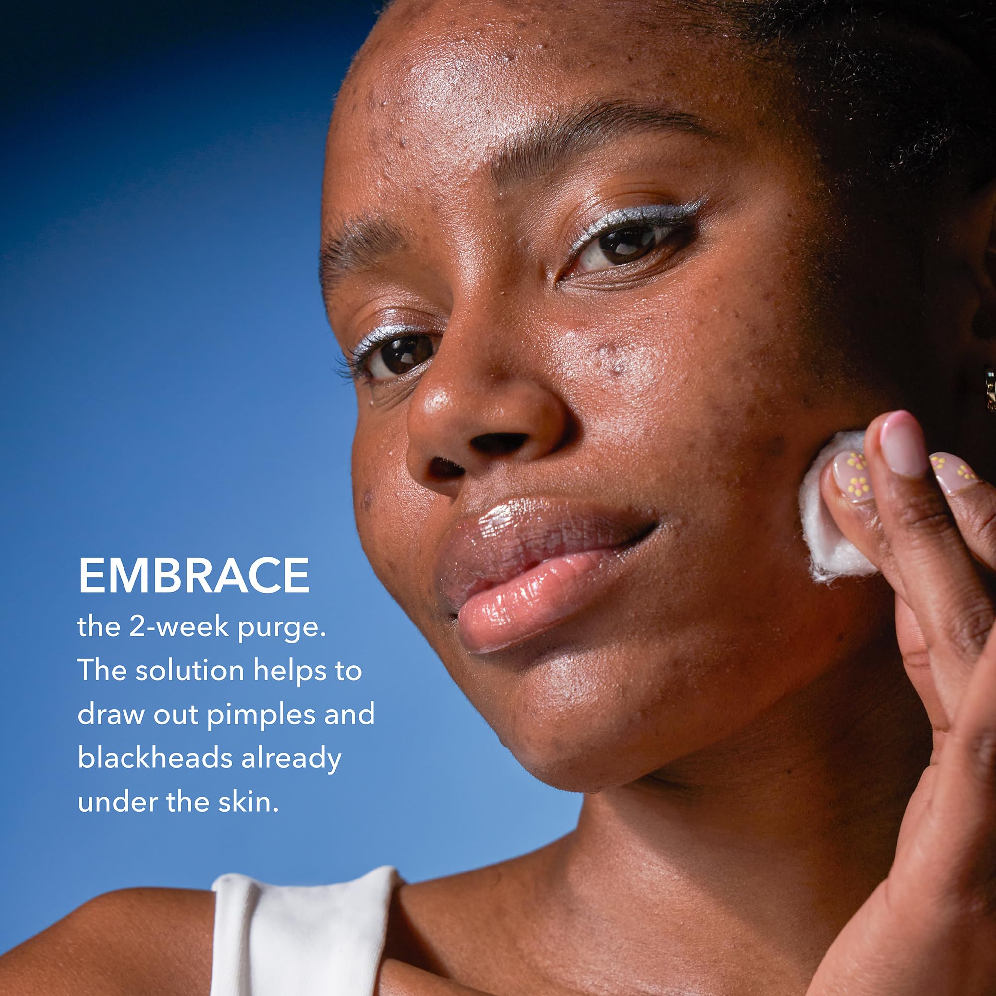Dr Dennis Gross Alpha Beta® 2% BHA+ Breakout Solution, Minimizes Pores, Clear & Prevent Breakouts, 5 Fl Oz - Image 7
