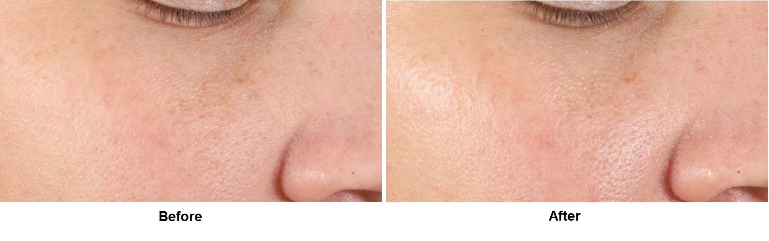 Dr. Dennis Gross Alpha Beta® Pore Perfecting & Refining Serum: for Enlarged, Clogged Pores with Excessive Oil, 1.0 fl oz - Image 6