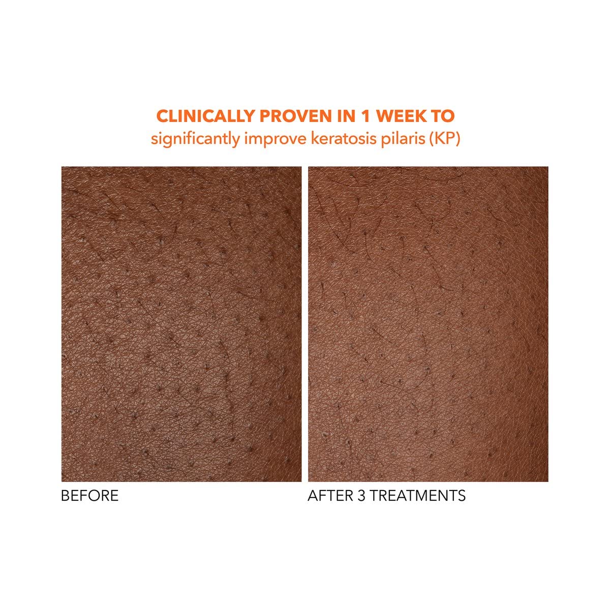 Dr. Dennis Gross Alpha Beta Exfoliating Body Treatment | Multi-Tasking Powered by AHA/BHAs for Smooth, Hydrated Skin While Improving Ingrown Hairs, Keratosis Pilaris, and Blemishes | 2 Textured Towels - Image 7