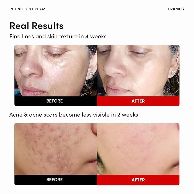 FRANKLY Retinol 0.1% Cream, 1.01 fl oz - Beginner Retinol | Night Cream | with Ceramides & Natural Ginseng | Anti-aging, Wrinkles Care, Reduces Congestion and hyperpigmentation | Korean Skin Care - Image 9