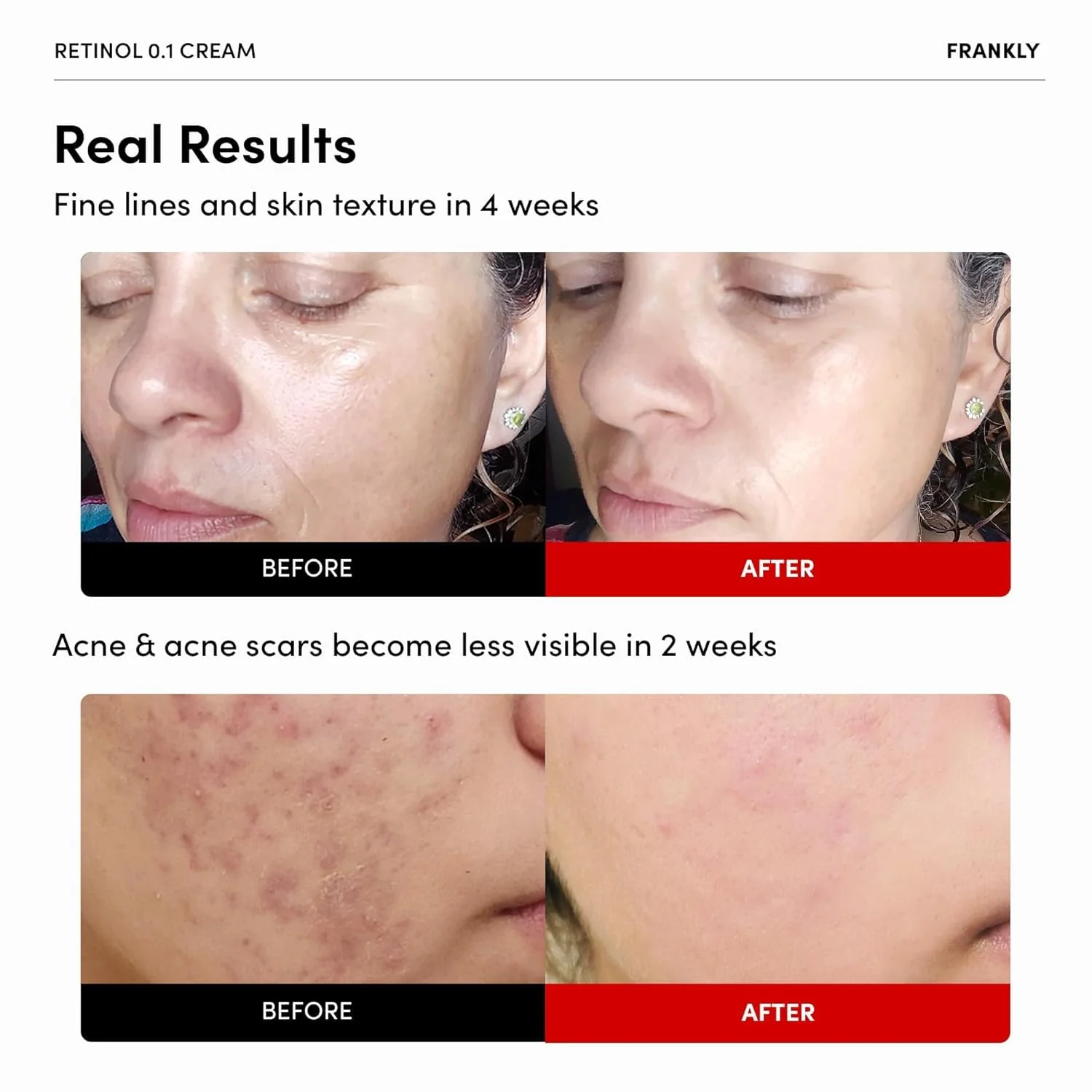 FRANKLY Retinol 0.3% Cream, 0.7 fl oz - Korean Intensive Retinol | Night Cream | Ceramides & Natural Ginseng | Anti-aging, Wrinkles Care, Reduces Congestion and hyperpigmentation | Korean Skin Care - Image 9