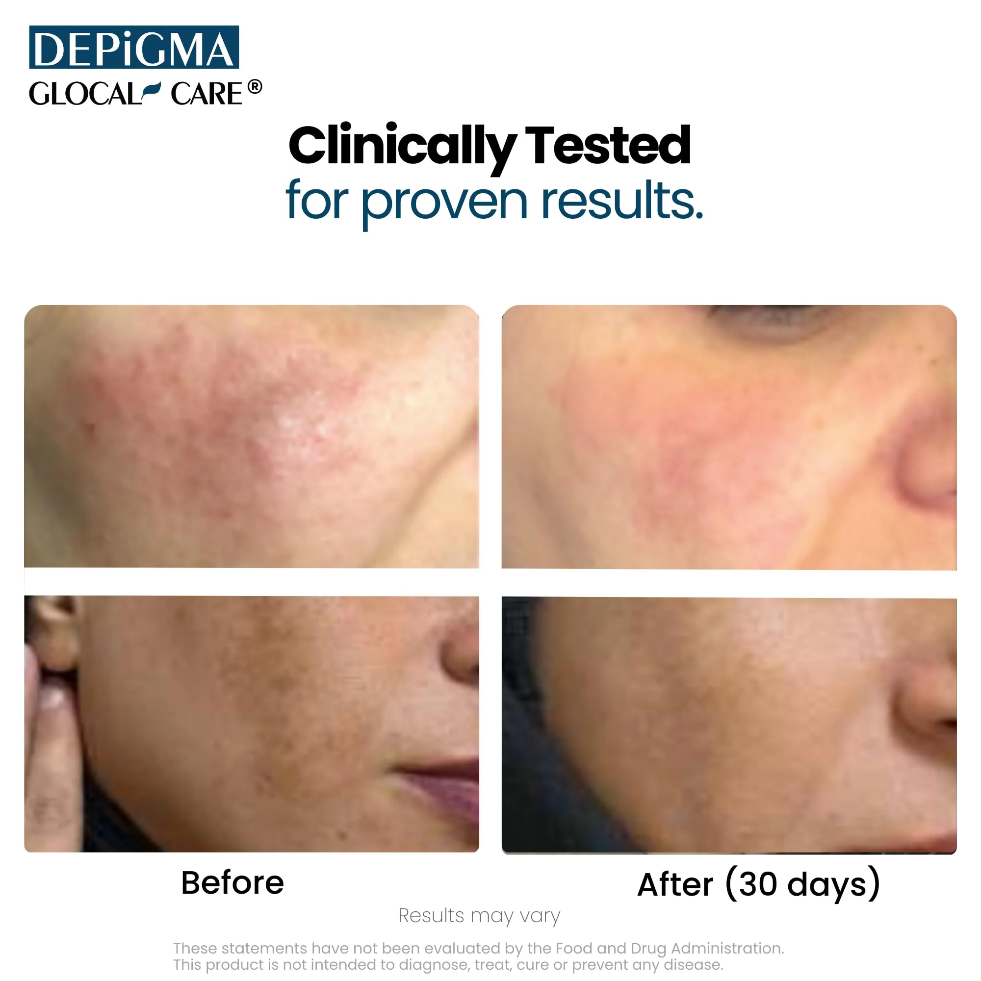 GlocalCare Depigma Support Reduction of Hyperpigmentation, Melasma & Dark Spots with Glutathione, Polypodium Leucotomos, Grape Seed & Marigold Extract - Image 7