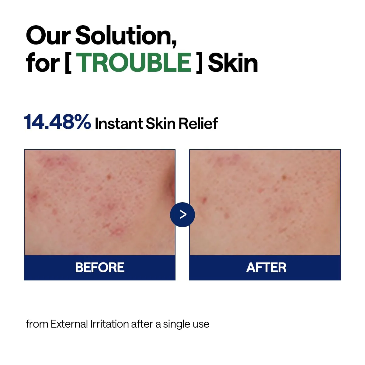 Mediheal Teatree Calming Serum 1.35 fl.oz - Quick Skin Calming and Redness Relief - Sebum Care, Oil Moisture Balance & Deep Moisturization with Hyaluronic Acid - Image 3