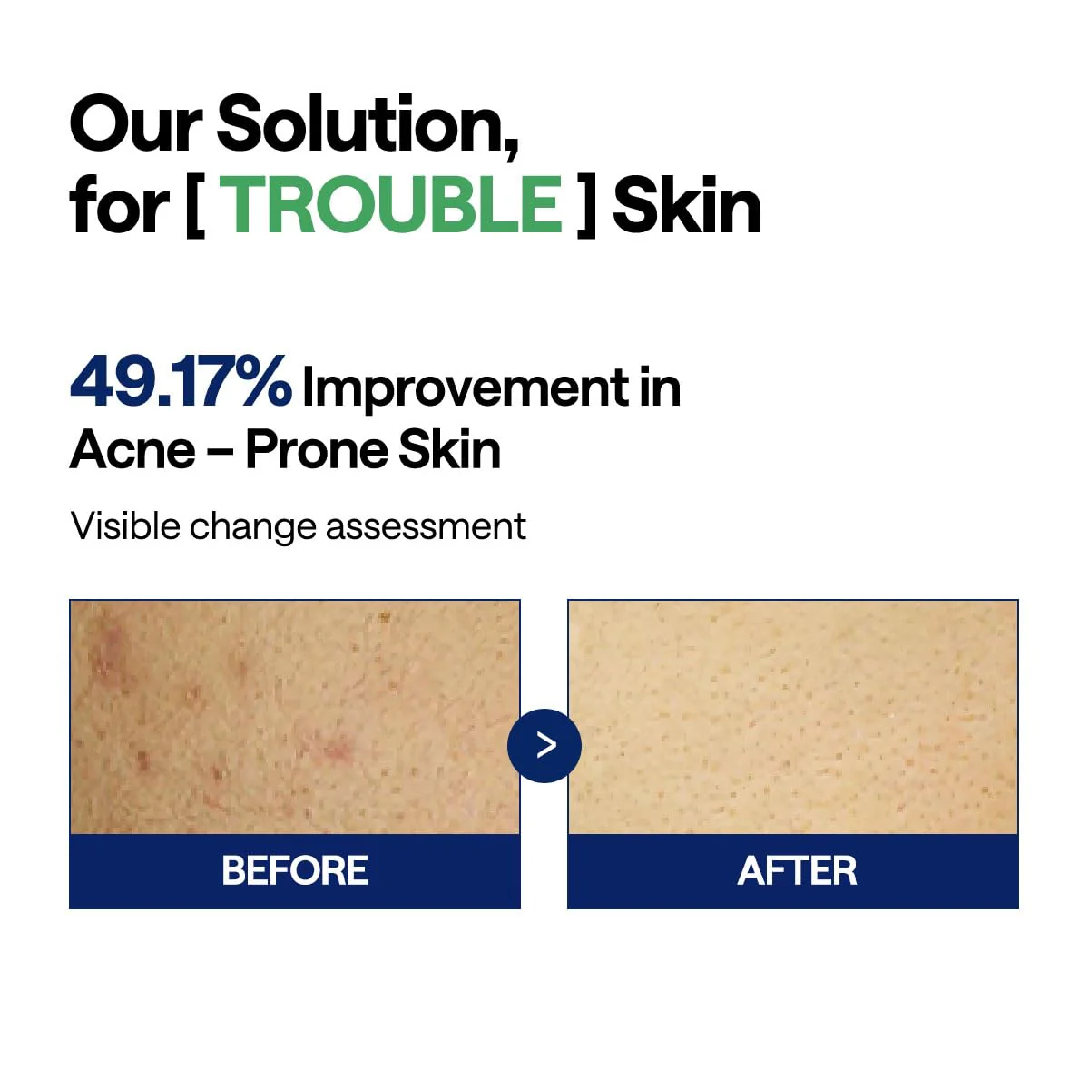 MEDIHEAL Teatree Trouble Pad - Square Cotton Facial Toner Pads with Tea Tree & Lactobacillus - Soothing to Calm Sensitive & Acne Prone Skin- Vegan Face Gauze 100 - Image 7