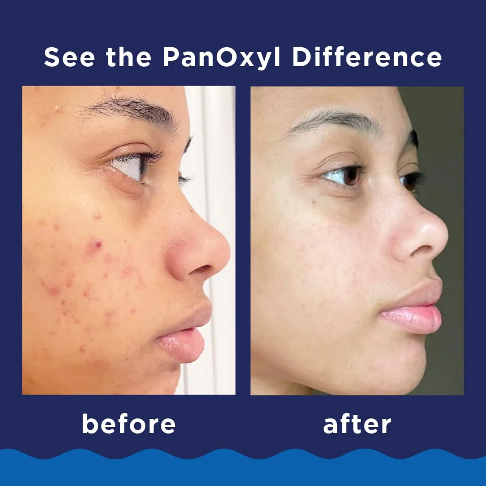 PanOxyl 10% Benzoyl Peroxide Acne Foaming Wash, Maximum Strength, Daily Acne-Fighting Face & Body Cleanser, Face Wash to Clear, Treat and Prevent Acne Pimples and Stubborn Breakouts, 5.5 Oz, Pack of 2 - Image 6