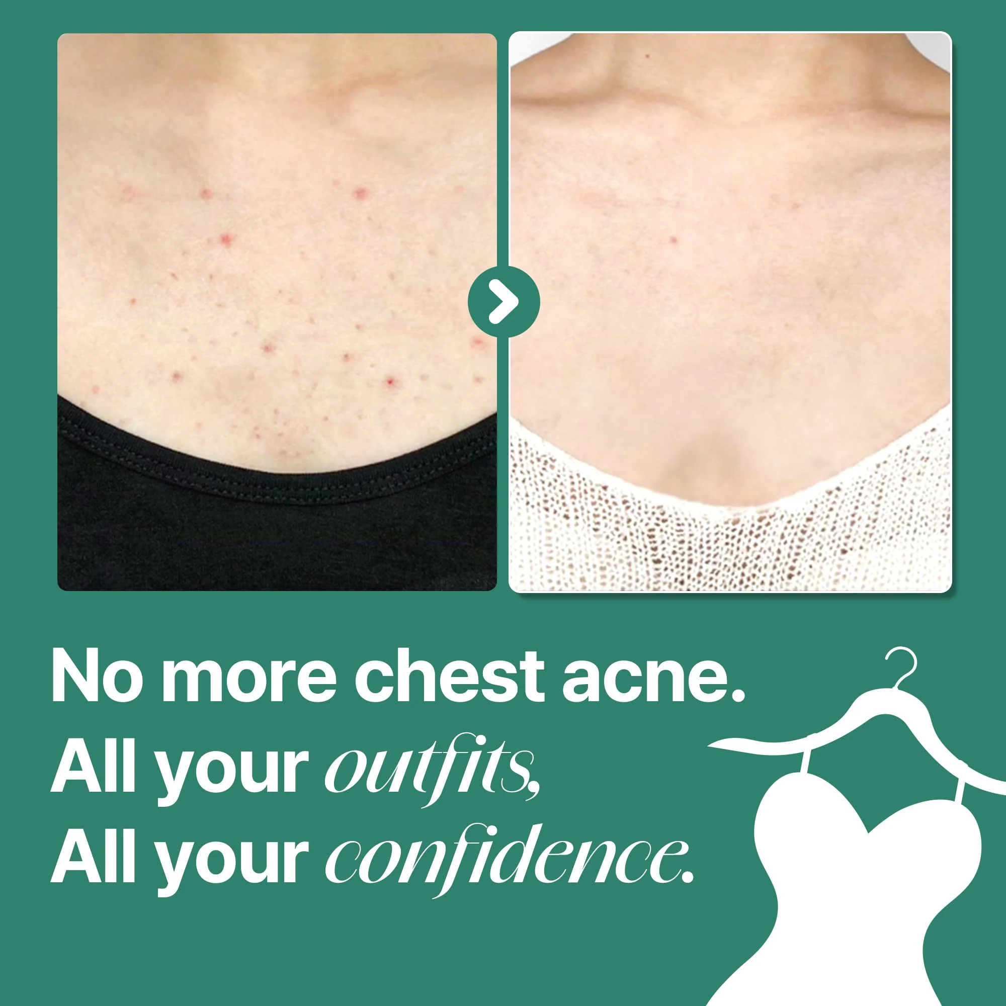 SOME BY MI AHA BHA PHA 30 Days Miracle Acne Clear Body Cleanser – Pack of 2 – Daily Exfoliating Tea Tree & Salicylic Acid Acne Body Wash – Deep Cleanses Sebum, Oil & Impurities – Korean Skin Care - Image 6