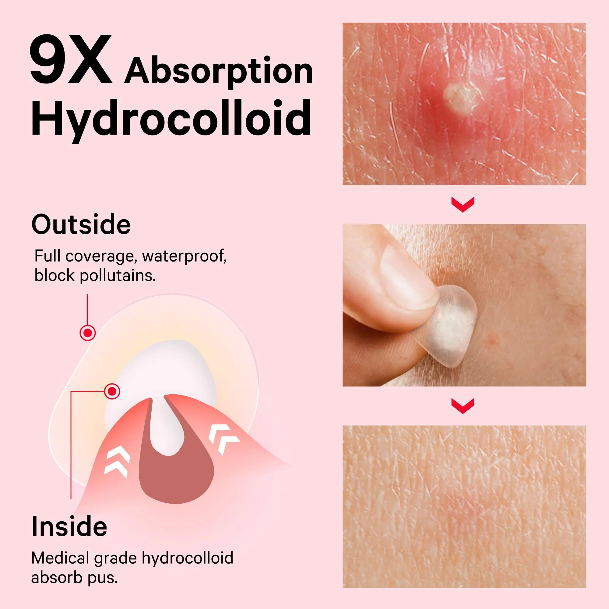 Sosky Pimple Patches for Face, Invisible Hydrocolloid Acne Patches, HSA Store Eligible Items, Zit Sticker for Face and Skin, Pimple Sticker for Covering Zits, Blemishes with Salicylic Acid 48 Count - Image 6