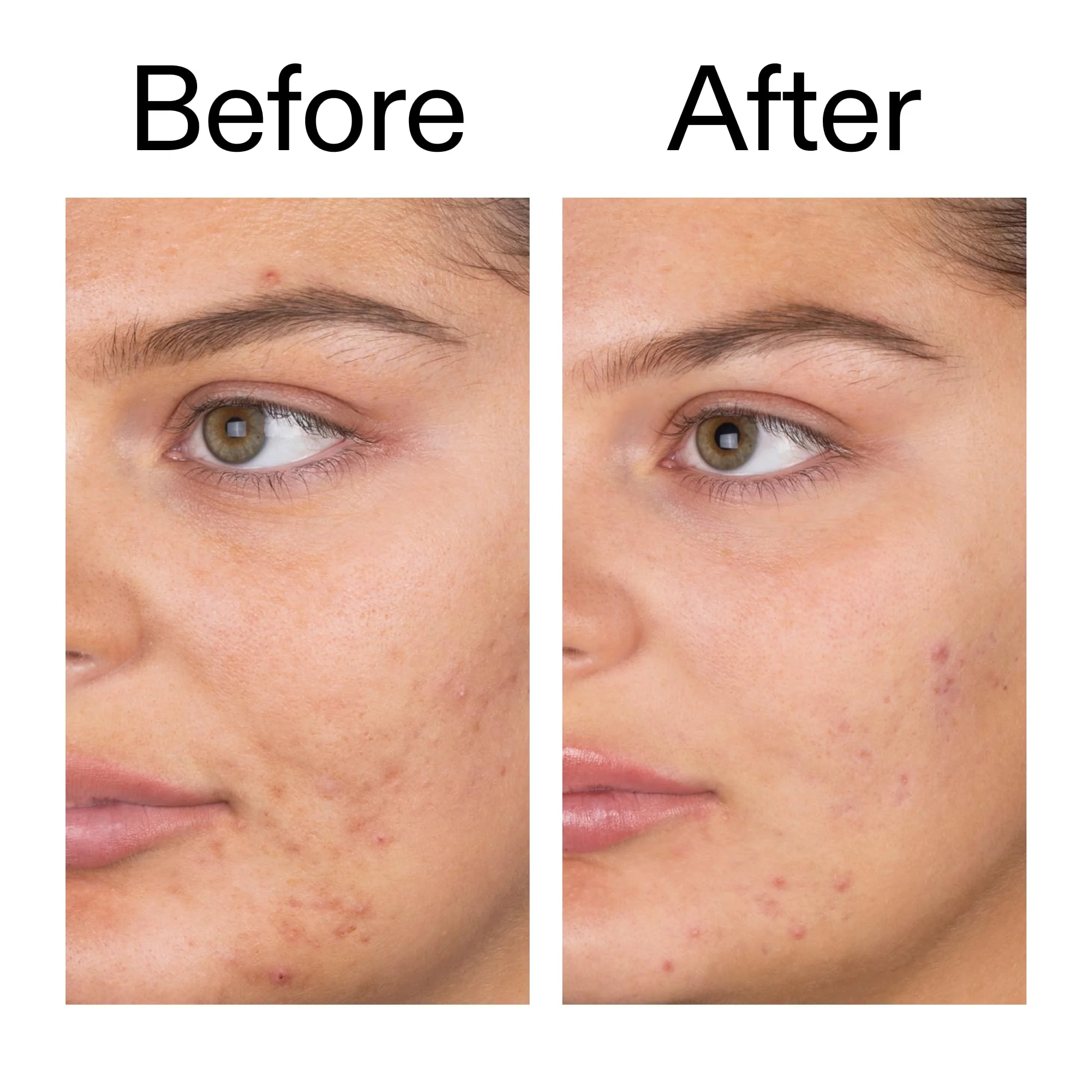 The INKEY List Salicylic Acid Cleanser - Daily Exfoliating Cleanser with 2% Salicylic Acid & Zinc PCA, Unclogs Pores, Anti Acne, Reduces Blackheads & Excess Oil for Clearer Skin - Image 3