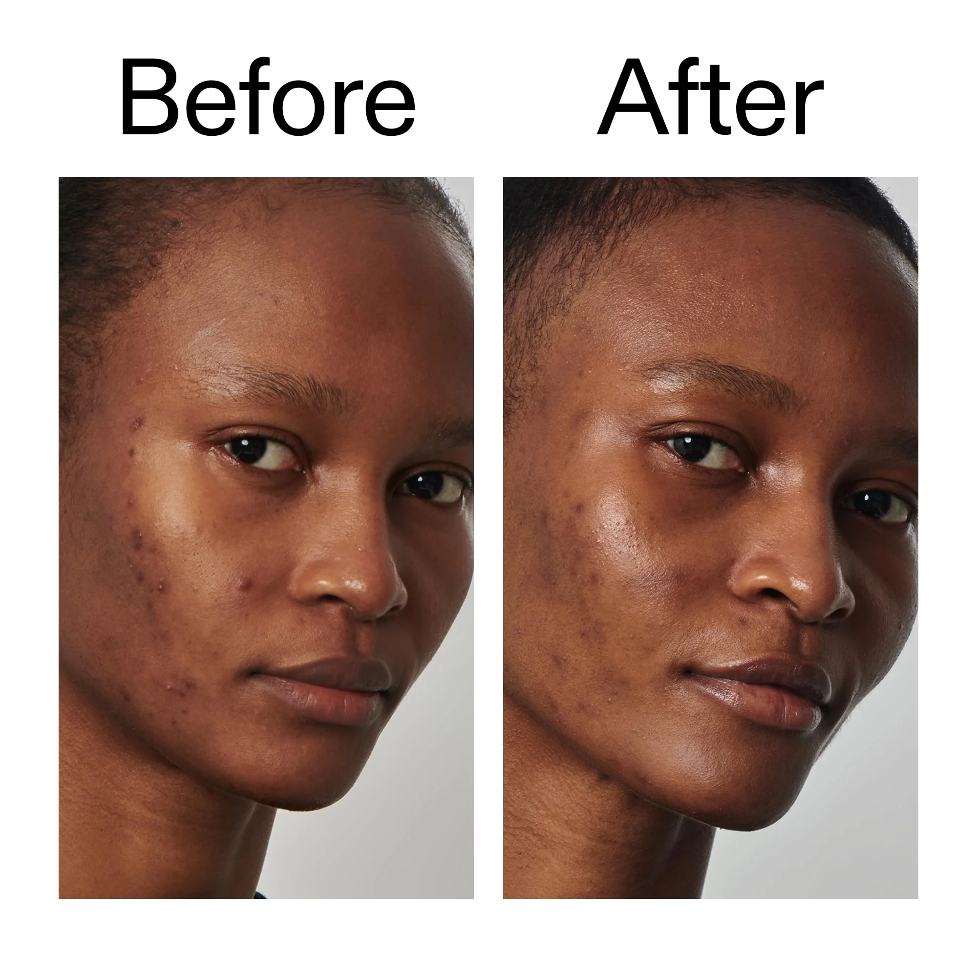 The INKEY List SuperSolutions Niacinamide 20% Serum, Helps with Healthy-Looking Skin Texture, Pores and Balancing Excess Oil, Skin Barrier Protection 1.01 fl oz - Image 2