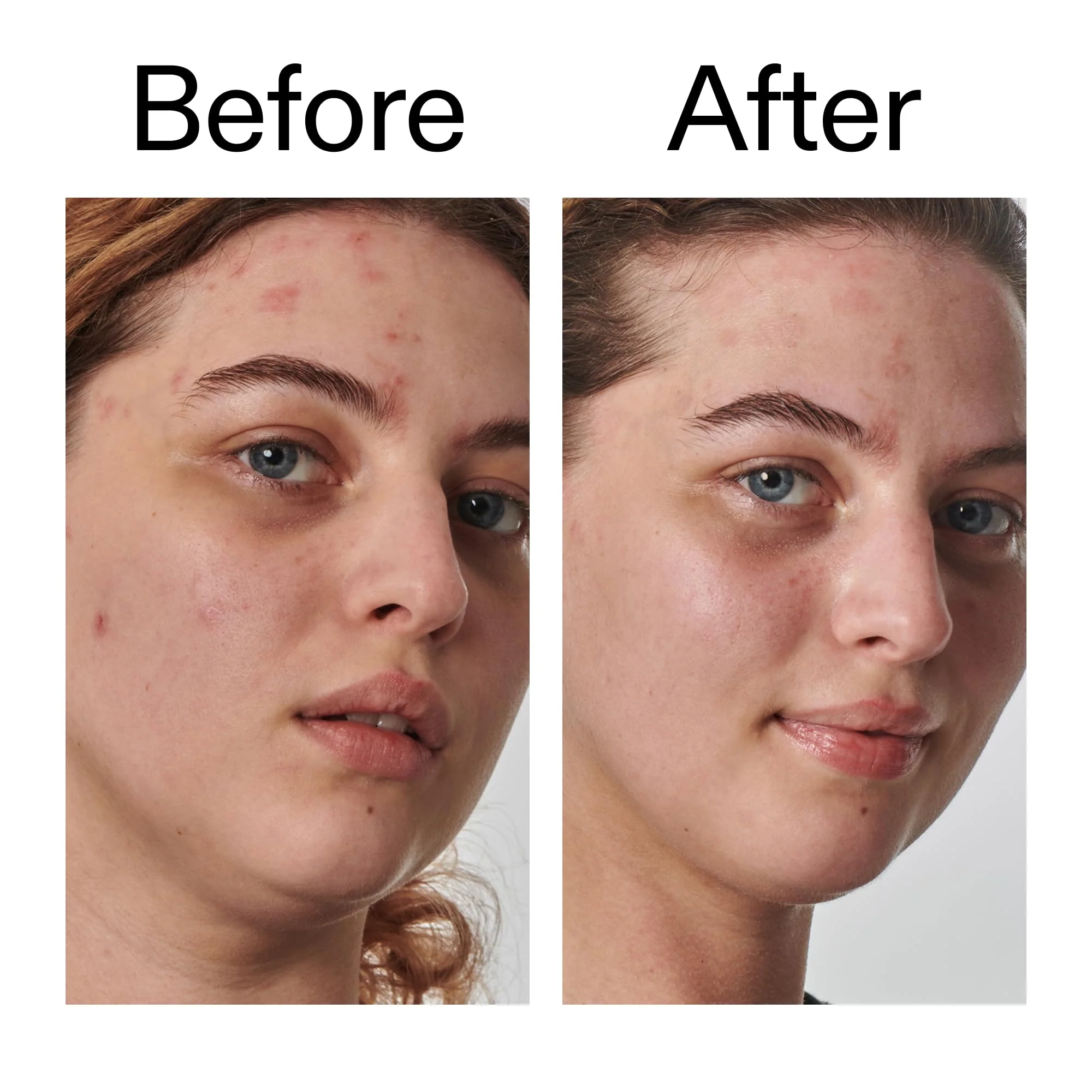 The INKEY List SuperSolutions Urea 10% Moisturizer, Quickly Helps to Hydrate, Nourish and Soothe Dry Skin, Gently Exfoliates, Urea Moisturizer for Face, 1.69 fl oz - Image 2