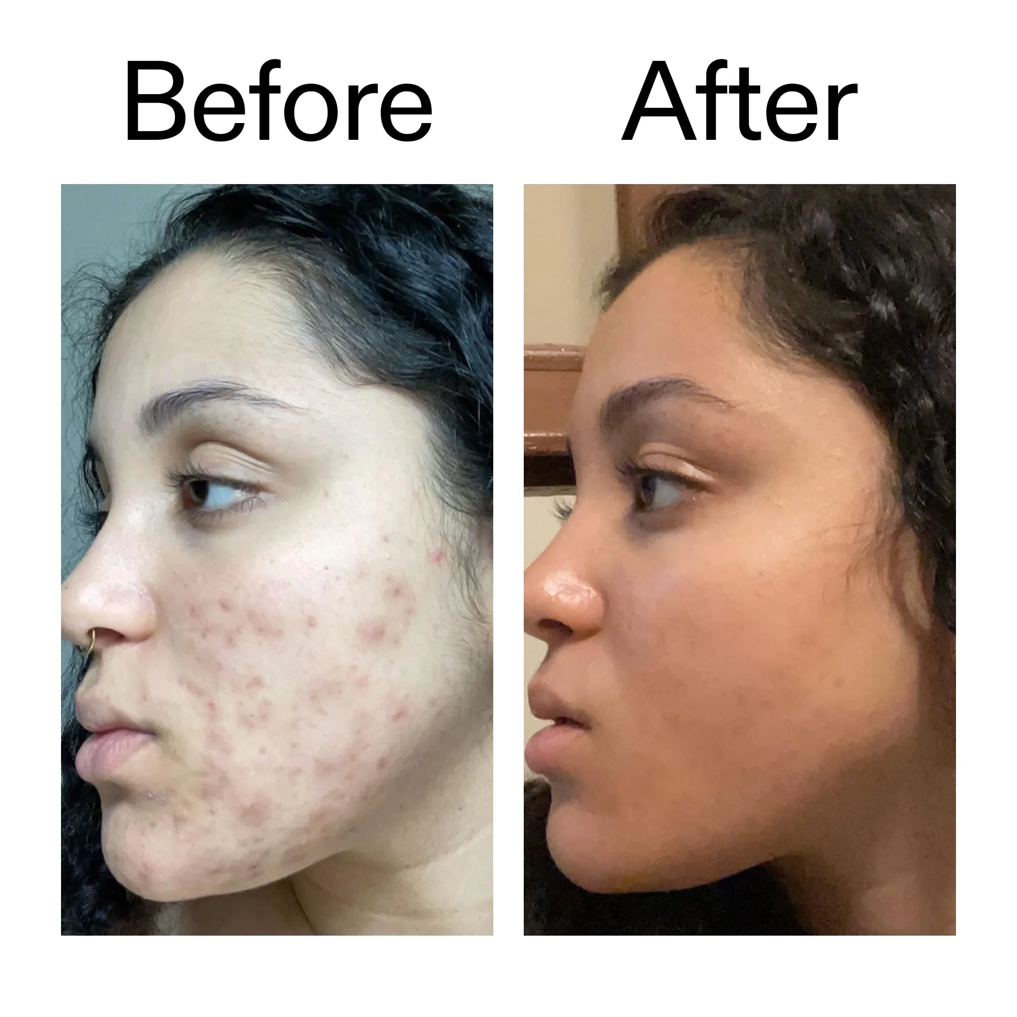 The INKEY List Tranexamic Acid Serum, Helps Reduce Appearance of Skin Discoloration, Dark Spots and Uneven Patches, Healthy-Looking Skin Tone, 1 fl oz - Image 2