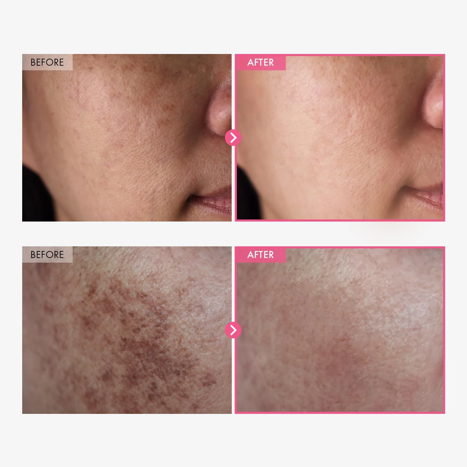 TOSOWOONG Arbutin 7% + Tranexamic Acid 4% Cream, 70,000ppm Arbutin, 40,000ppm TXA, Niacinamide, Glutathione, Dark Spots, Freckle, Blemishes, Pigmentation, Korean Skin Care, 50ml, 1.69 fl.oz. - Image 6