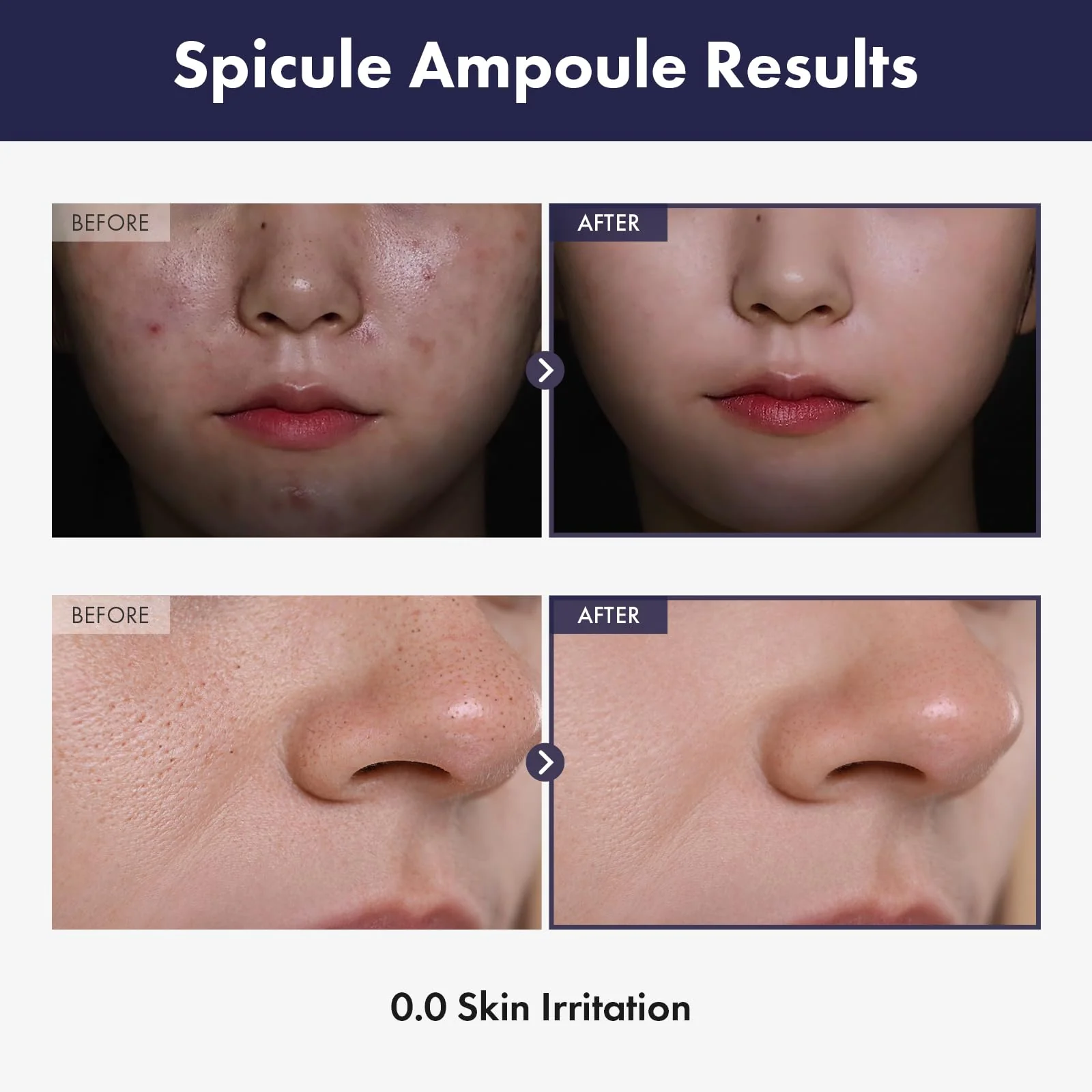 TOSOWOONG Real Spicule Ampoule with 30,000 Shots, Niacinamide, Panthenol, Liquid Skin Booster Serum, Pore Minimizer, Exfoliating, Dead Skin Cells, Skin Texture, Korean Skincare, 30ml, 1.01 fl. oz. - Image 7