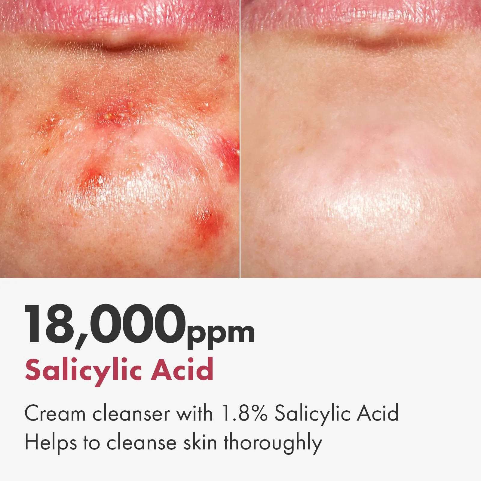 TOSOWOONG Salicylic Acid Foam Cleanser for Oily Skin, 18,000ppm Salicylic Acid, Deep Pore Cleansing, Face Wash For Breakouts, Exfoliating Cleanser, Korean Skin Care, 100ml, 3.38 fl. oz. - Image 6