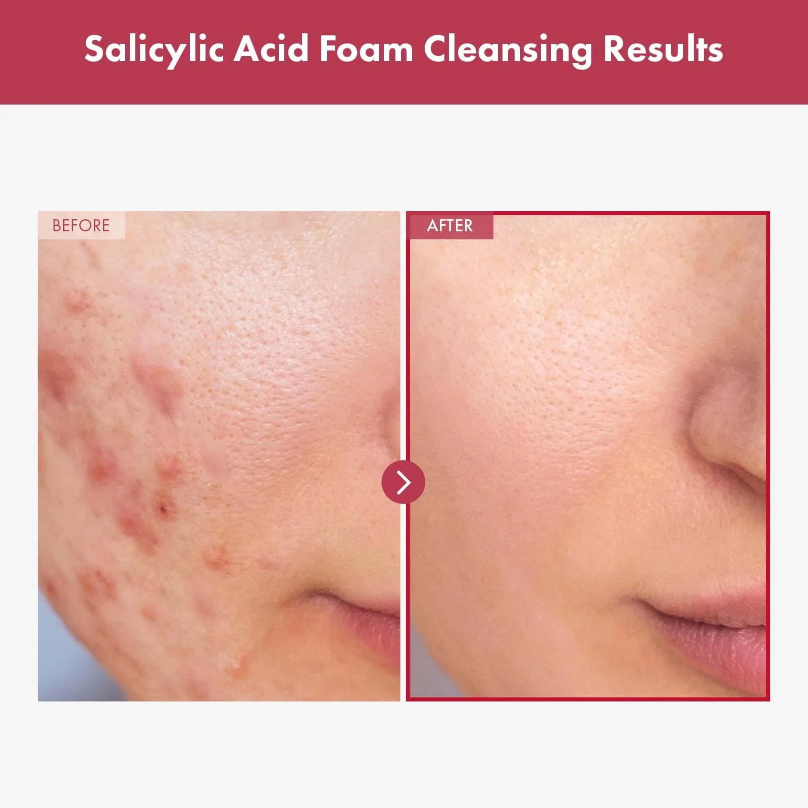 TOSOWOONG Salicylic Acid Foam Cleanser for Oily Skin, 18,000ppm Salicylic Acid, Deep Pore Cleansing, Face Wash For Breakouts, Exfoliating Cleanser, Korean Skin Care, 100ml, 3.38 fl. oz. - Image 7