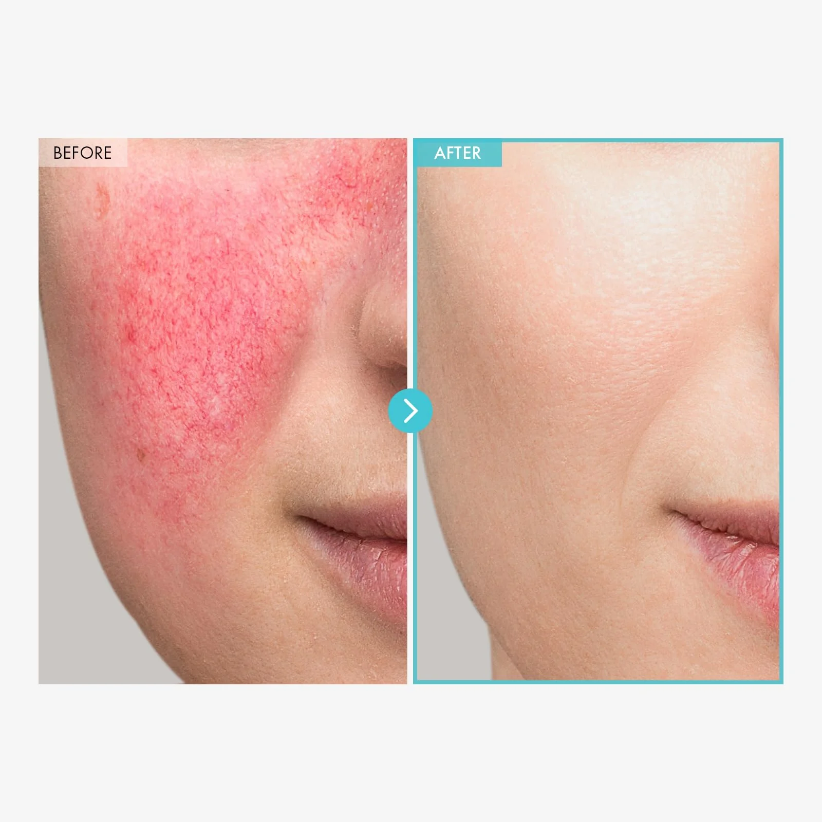 TOSOWOONG SOS Repair CICA Clinic Zinc Cream, 100,000ppm Zinc Oxide, Heal, Soothe Acne, Redness, Rosacea Treatment, Skin Barrier Repair, Moisture, Non-Comedogenic, Korean Skincare, 50g, 1.76 oz. - Image 4
