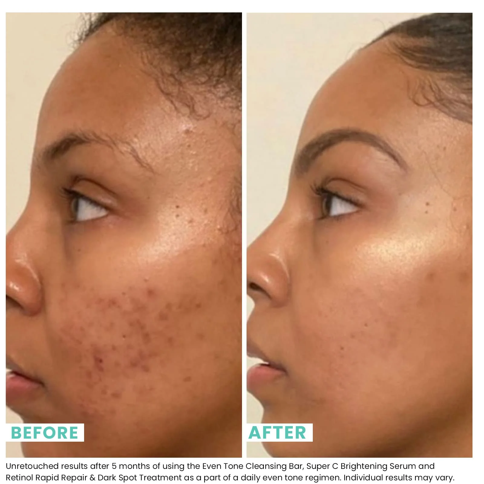 Urban Skin Rx® Even Tone Cleansing Bar | 3-in-1 Multitasking Treatment Daily Cleanser, Exfoliator, & Mask | Targets Uneven Skin & Improves the Appearance of Dark Spots | Includes Applicator | 2.0 Oz - Image 6