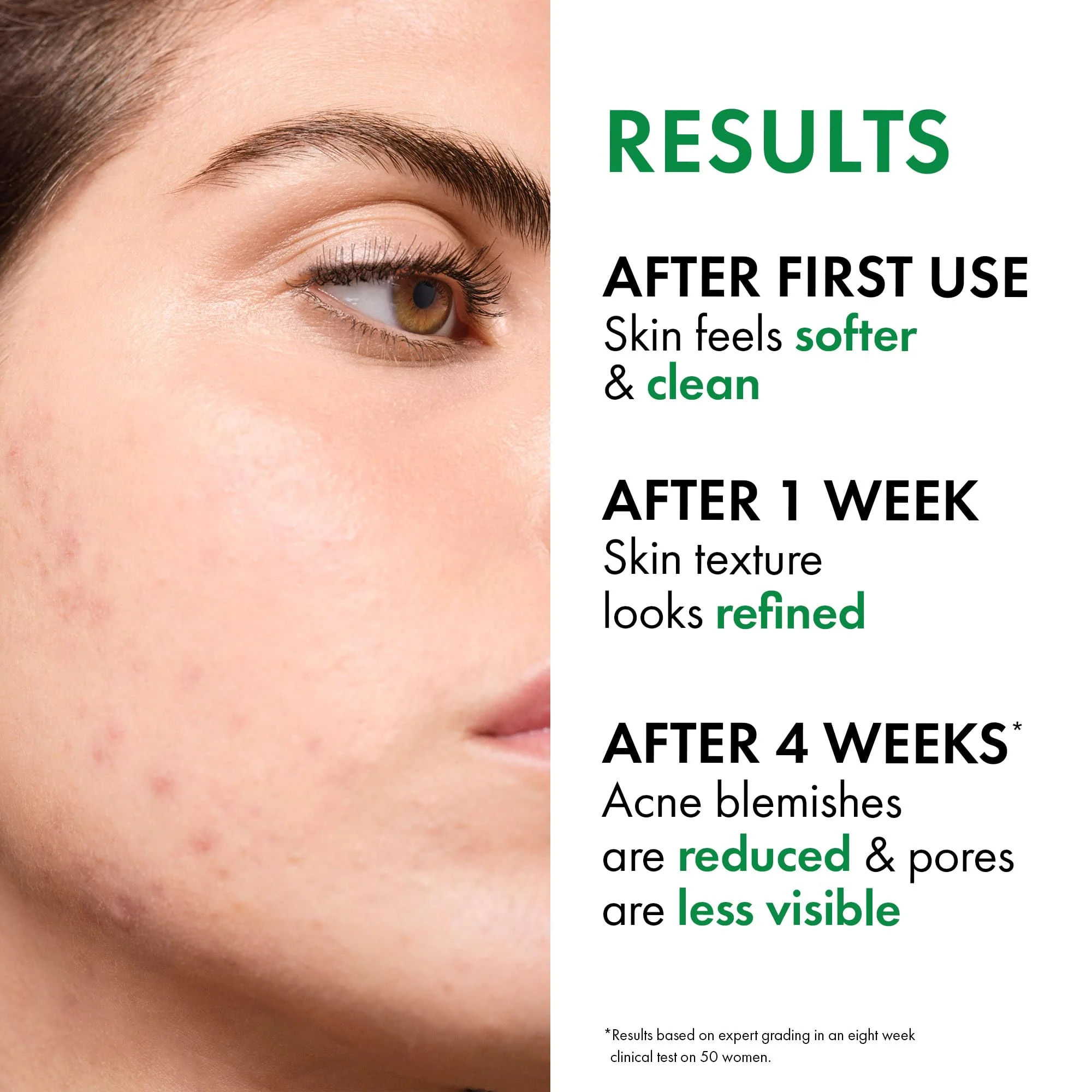 VICHY Normaderm Acne Control Daily Moisturizer, Oil Free Acne Moisturizer For Face, Max Strength 2% Salicylic Acid + Hyaluronic Acid + Vitamin C, Targets Blackheads, Blemishes & Enlarged Pores - Image 8